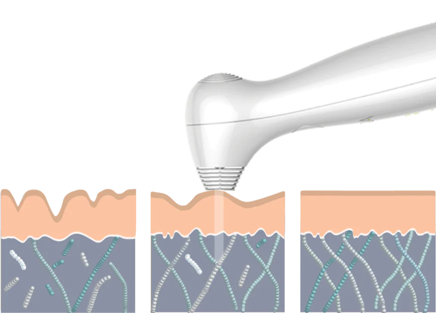 NIRA Precision Laser